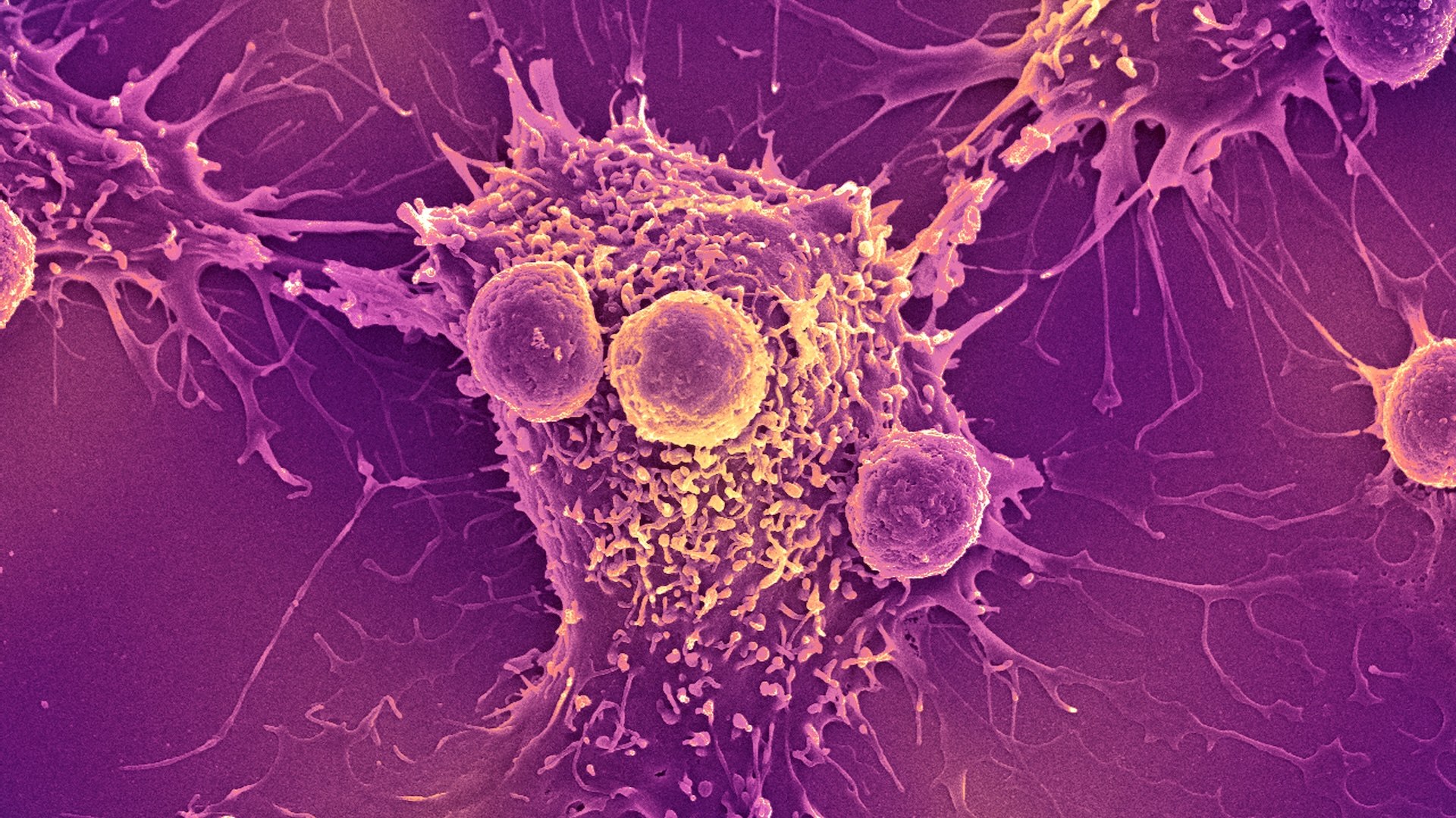 Cancer cell and T lymphocytes, SEM