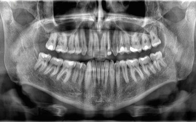 Why don’t teeth count as bones?
