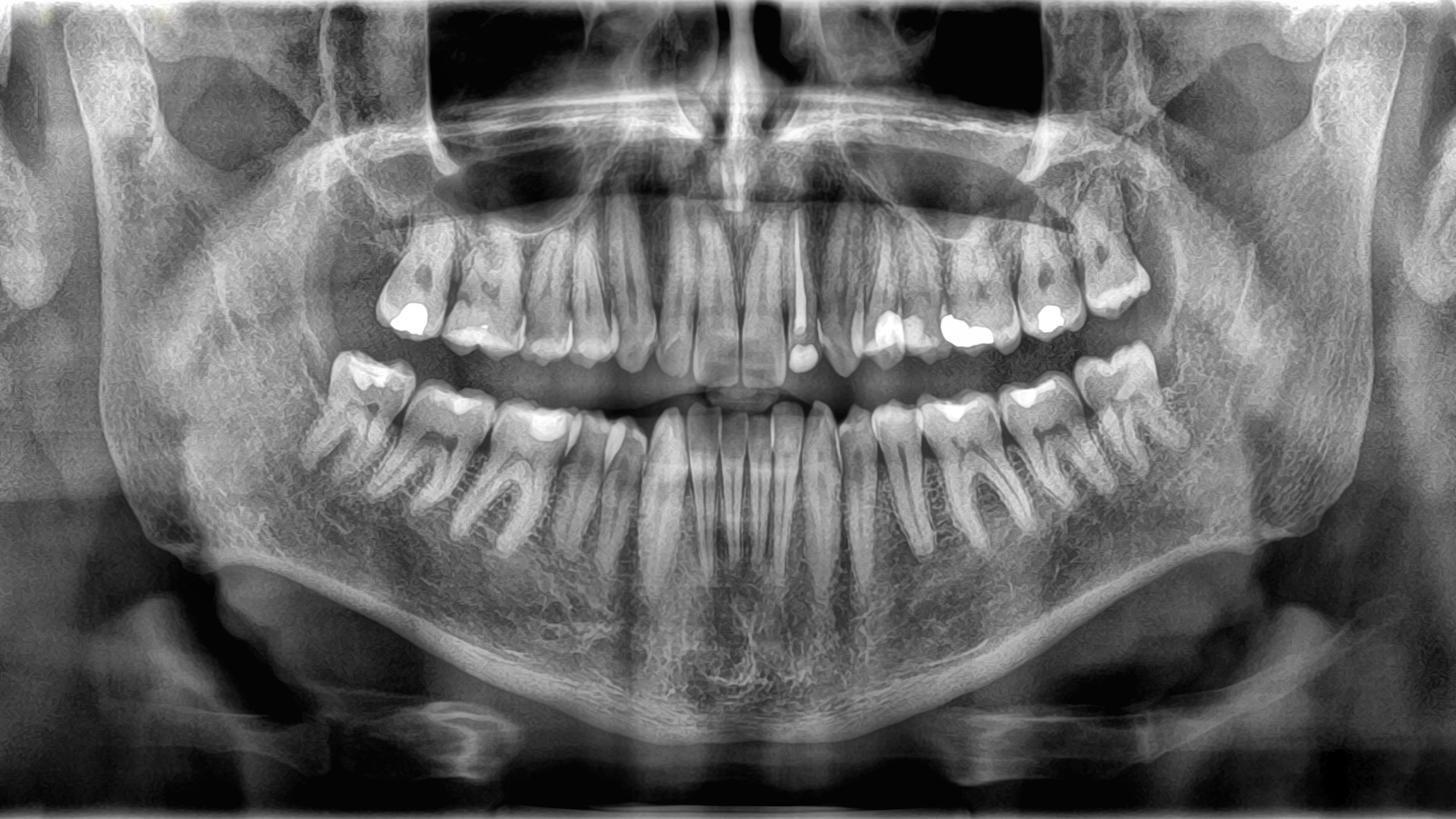 3D panoramic X-ray of an adult male’s teeth
