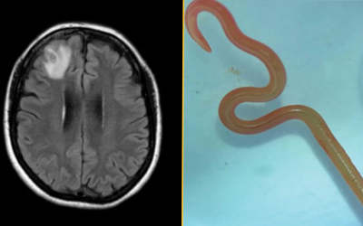 A parasite never before seen in humans was behind a woman’s lung infection, organ damage and forgetfulness