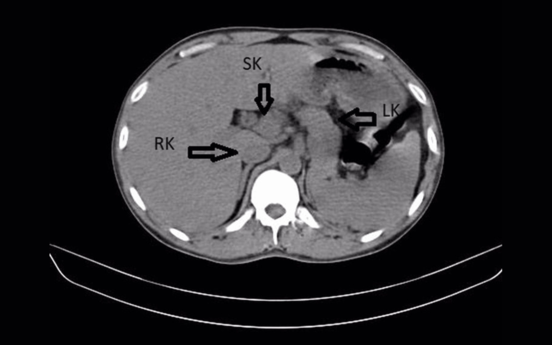 A man went to the doctor for a bad UTI and learned he had an extra kidney