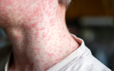 Measles’ resurgence in the US is a grim sign of what’s coming