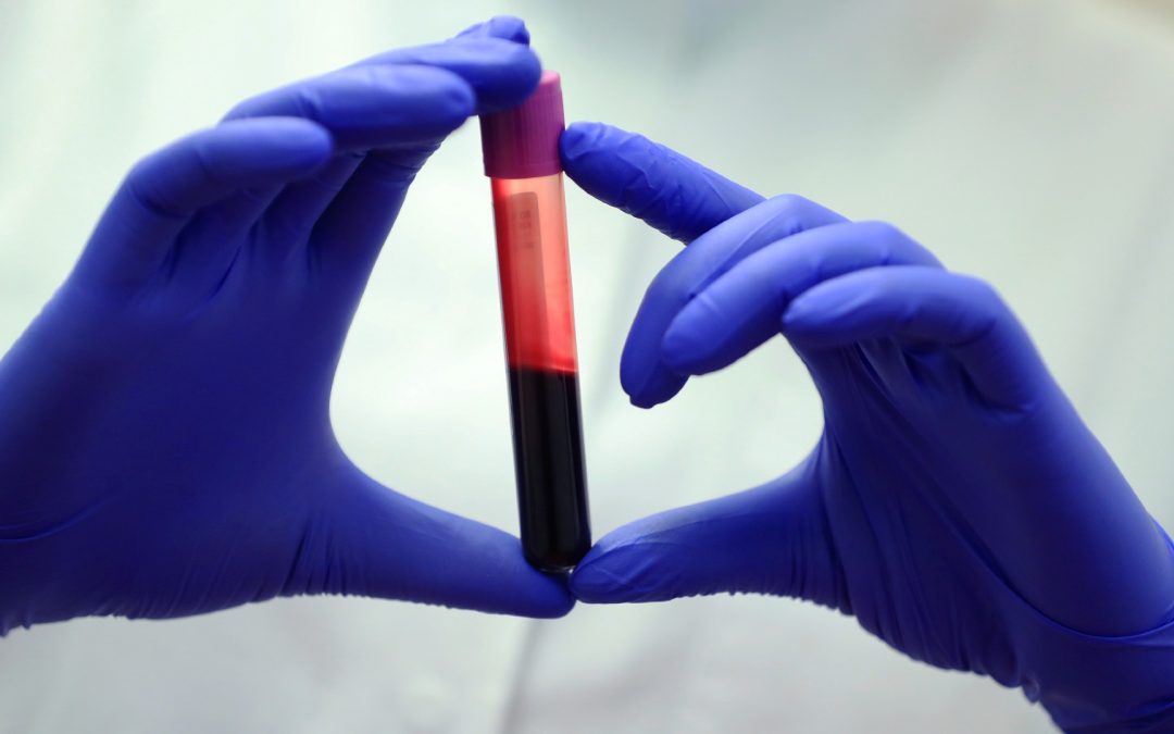 New blood test aims to spot liver scarring before it paves the way to cancer