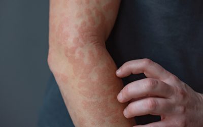Keratin may act as a ‘brake’ for skin inflammation, pointing to potential treatments